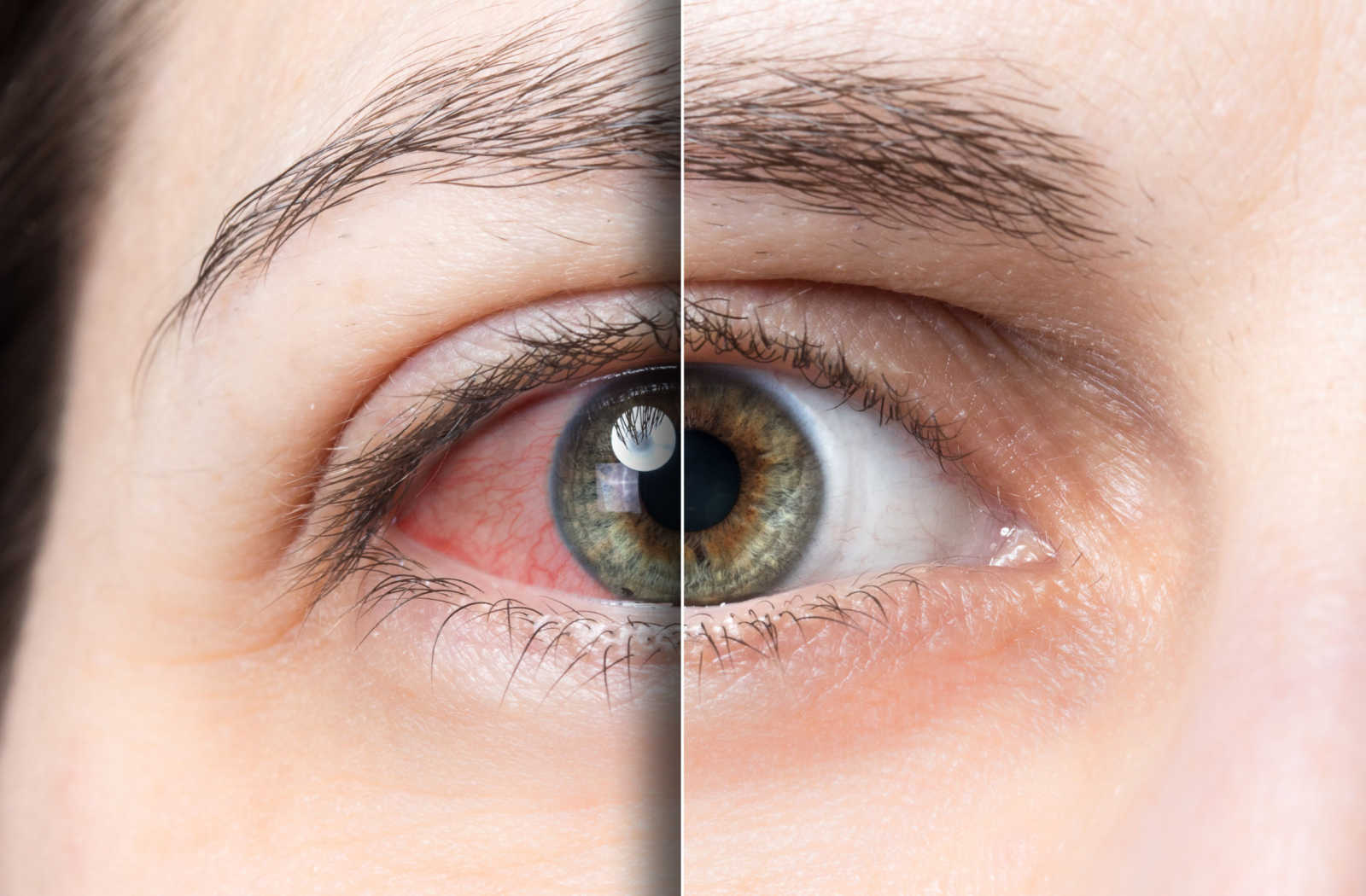 Side by side comparison of an irritated eye. The left side of the image shows a close-up of a person's eye with a noticeable redness. The right side of the image shows the same eye after the redness has been treated.