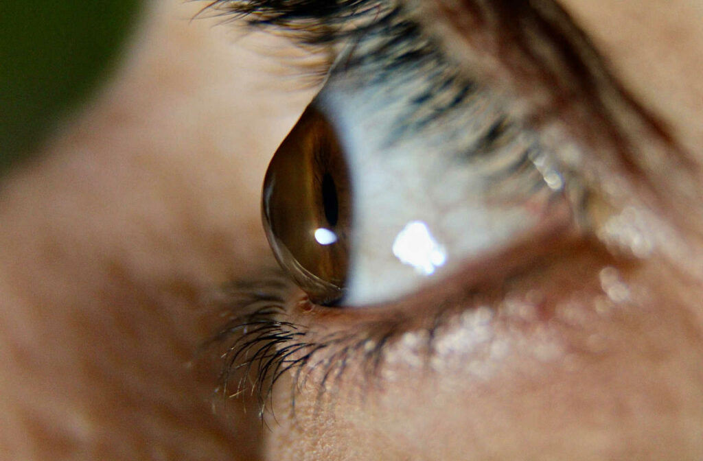 Up close photo of a male patient exhibiting keratoconus in the left eye.