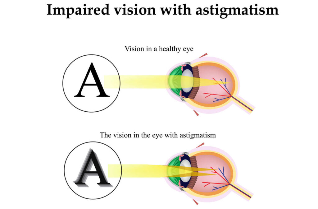 An image comparing what the letter A looks like to a normal eye compared to an eye with an astigmatism.