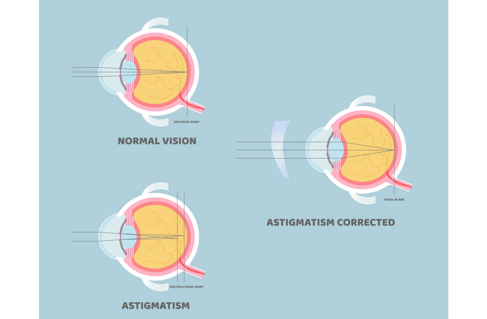 Drawing showing regular light refraction, compared to an eye with astigmatism and after correction.