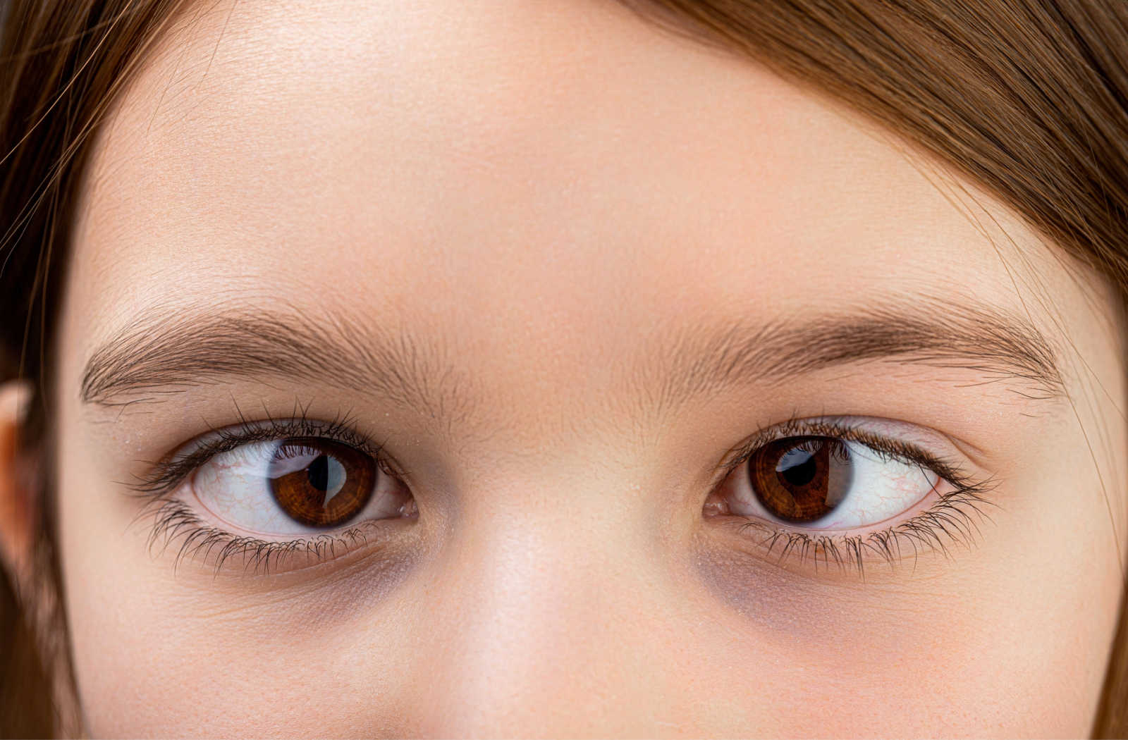 A young girl with visible strabismus.