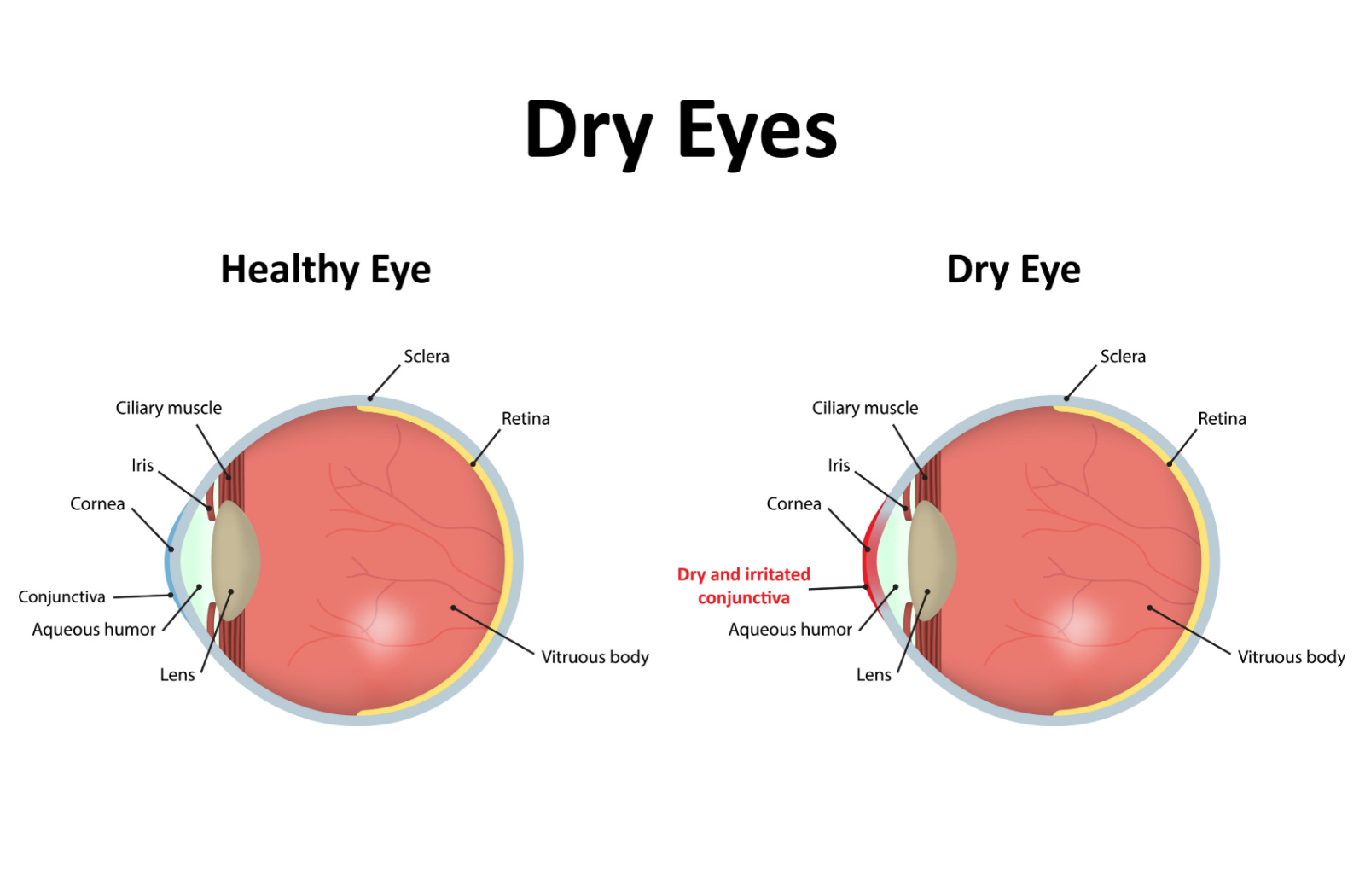 Cross section graphic of two eyes showing a healthy eye vs the conjunctiva irritation of a dry eye.